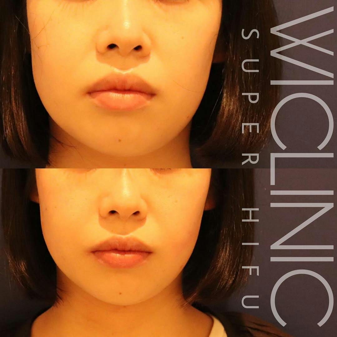 【20代女性・小顔】スーパーハイフ_before_aftar