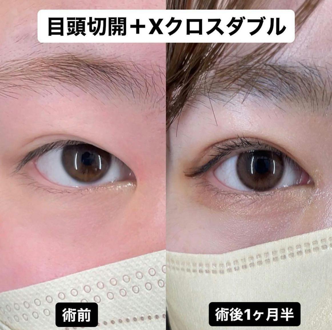 【女性・目元】Xクロスダブル(埋没二重) 目頭切開_before_aftar