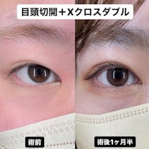 【女性・目元】Xクロスダブル(埋没二重) 目頭切開_before_aftar