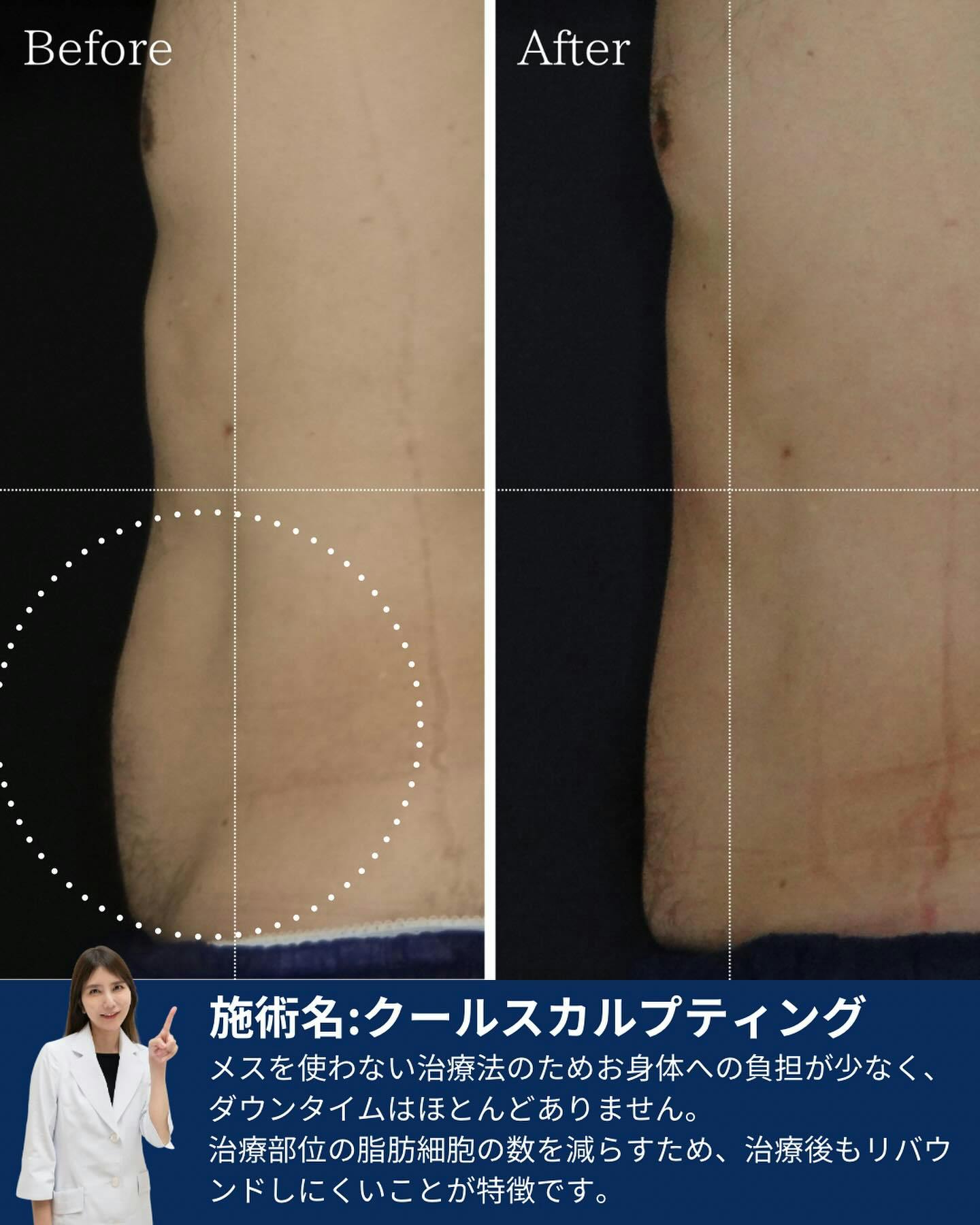 【男性・腹部】クールスカルプティング　下腹部・側部レギュラー_before_aftar