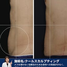 【男性・腹部】クールスカルプティング 下腹部・側部レギュラー_before_aftar