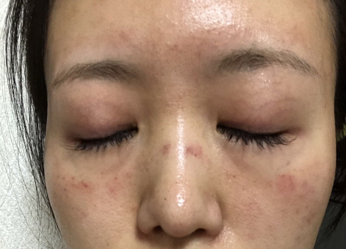 品川スキンクリニック宇都宮院（※品川美容外科提携）でを受けたSaki9991さんの写真