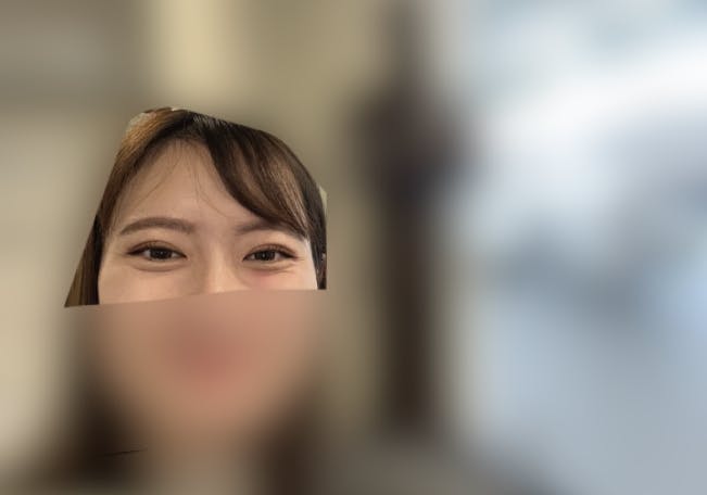 湘南美容クリニック 大阪駅前院で二重整形・二重埋没・奥二重整形・末広二重整形・平行二重整形・ミックス型二重整形・目元整形を受けたゆったさんの写真