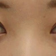 【女性・目元】クイックコスメティーク・ダブルNeo、SBC『デカ目』術_before