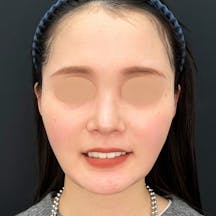 【女性・輪郭】美ボディ脂肪吸引_after