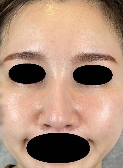 TCB東京中央美容外科 新宿東口院で目の下のクマ・たるみ・しわ取り：クマ取り再生注射を受けたGenieさんの写真