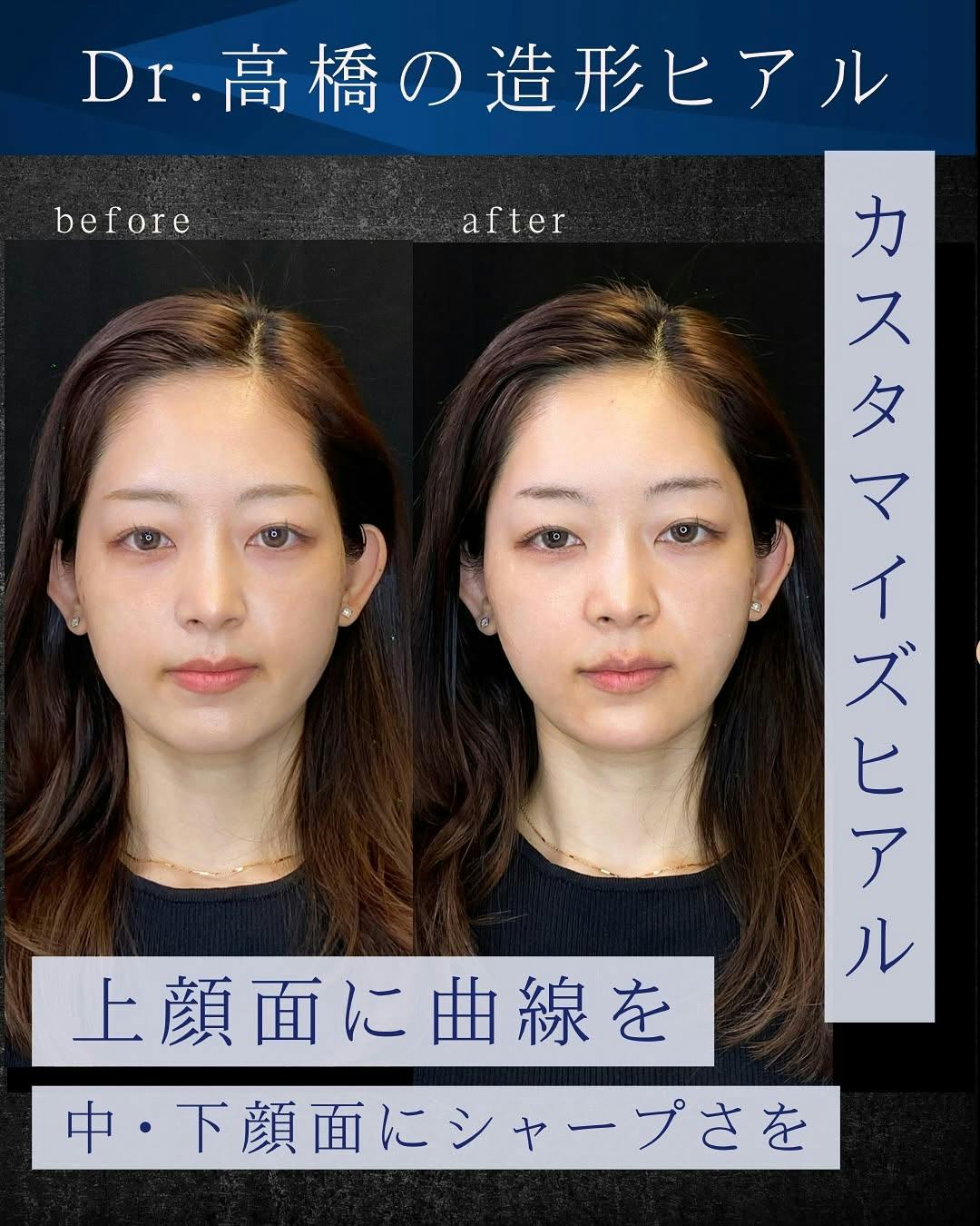 【女性・輪郭】カスタマイズヒアル_before_aftar