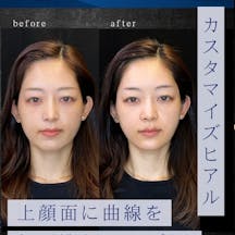 【女性・輪郭】カスタマイズヒアル_before_aftar