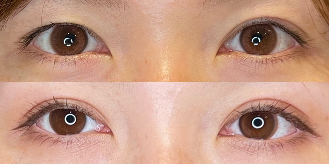 「固定力×自然さ」どちらも妥協しない。癒着でラインを“育てる”埋没法の画像