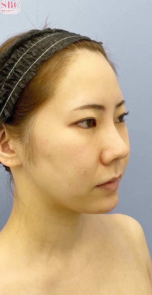 【女性・輪郭】Aquicell（アキーセル）脂肪吸引、メーラーファット除去術、根こそぎVASER脂肪吸引_before