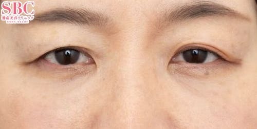 【50代女性・目元】目の下の切らないクマ・たるみ（ふくらみ）取り、ナチュラル脂肪注射コンデンスリッチ、ナチュラル脂肪注射ナノリッチ、VOVリフト_after