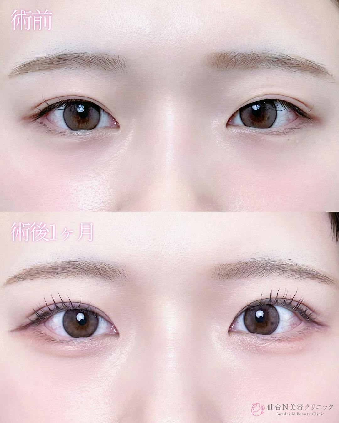 【女性・目元】二重埋没法（シークレットトリプル）_before_aftar