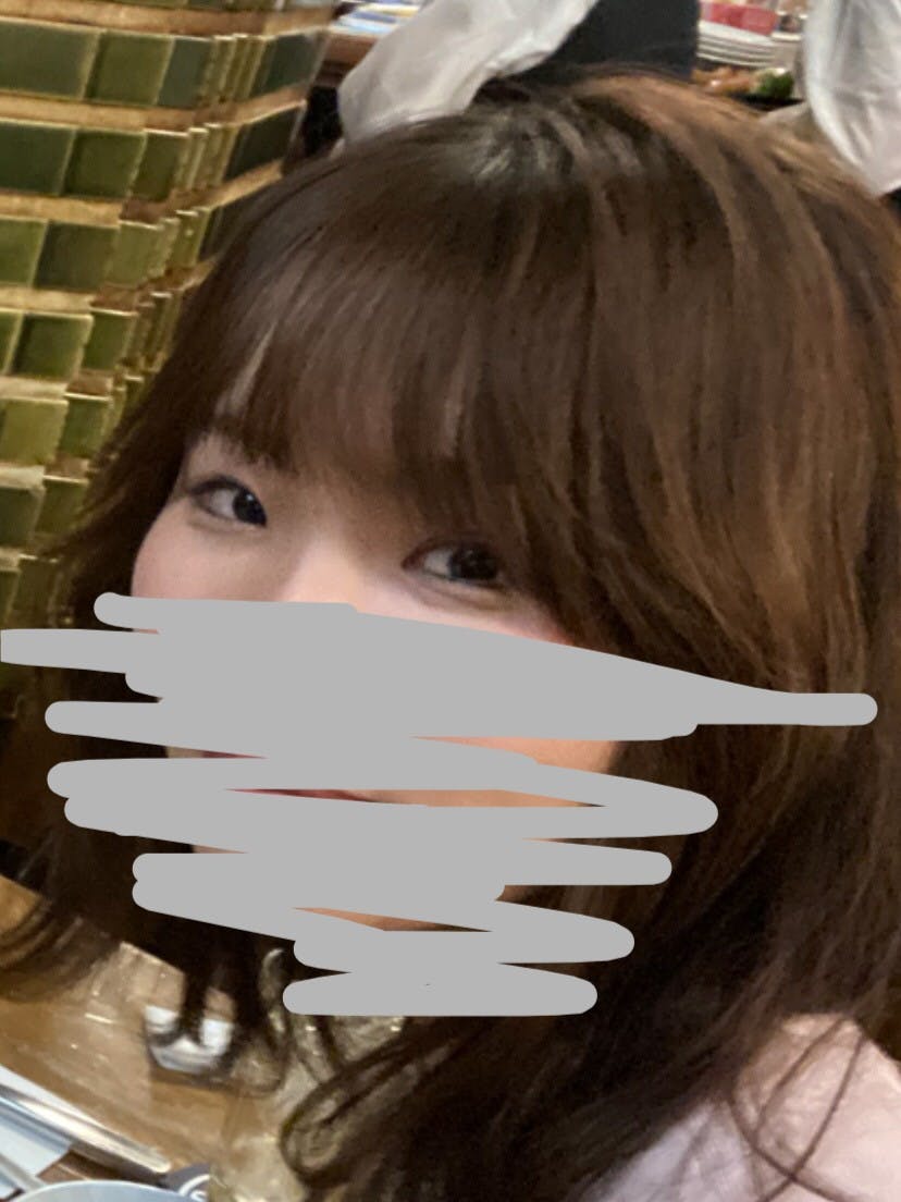 芦屋美容クリニックで切る眼瞼下垂を受けた山藤さんの写真