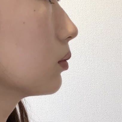 TCB東京中央美容外科 久留米院でヒアルロン酸（顎）を受けたMSさんの写真