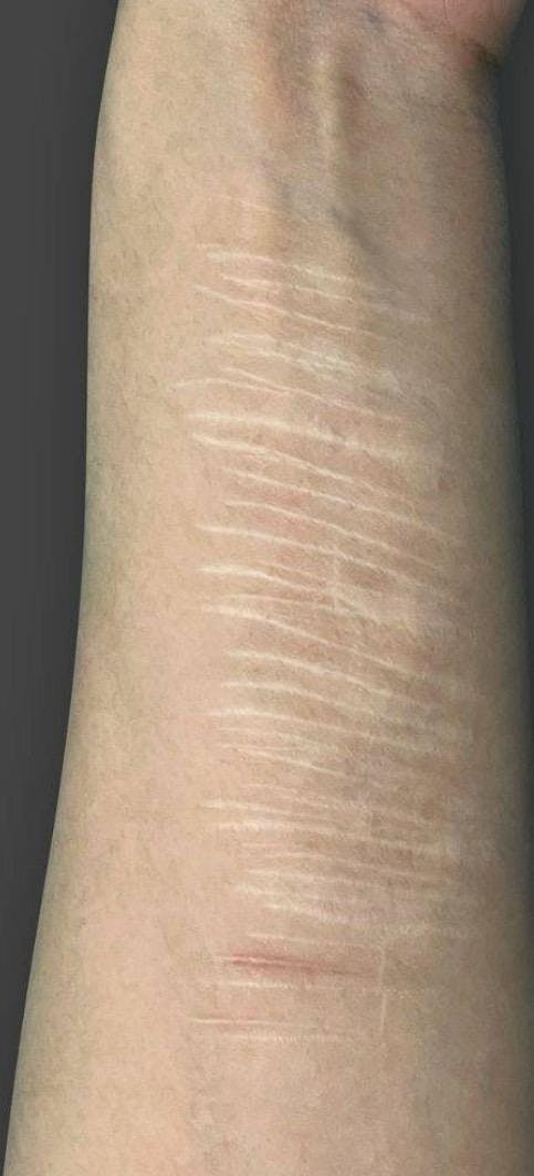 西新宿杉江中央クリニックで傷跡修正:切開法を受けた大貫さんの写真