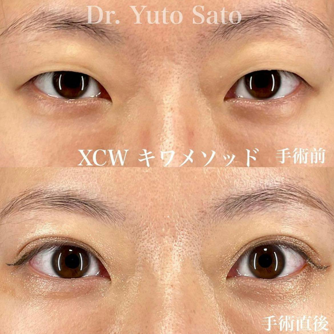 【目元】Xクロスダブル(両目) デカ目術(切らない眼瞼下垂術)_before_aftar