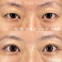 【目元】Xクロスダブル(両目) デカ目術(切らない眼瞼下垂術)_before_aftar