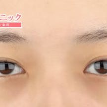 【女性・目元】眉下リフト(眉下切開)目頭切開プレミアム_before