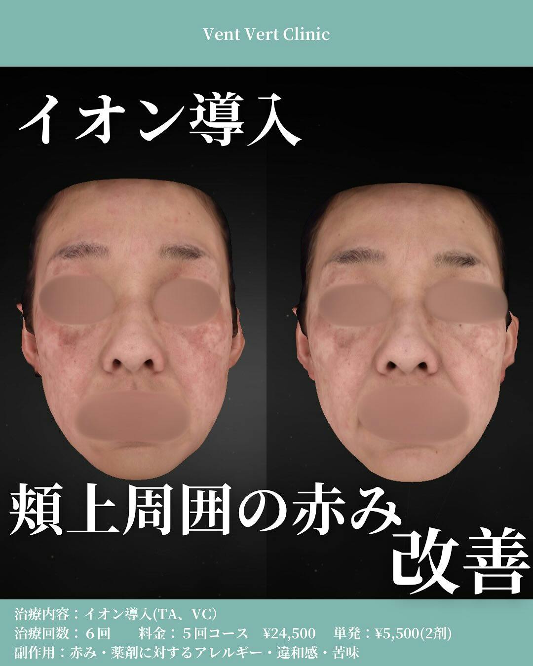 肌イオン導入 イオン導入 - 銀座・名古屋・心斎橋の美肌治療は椿クリニック