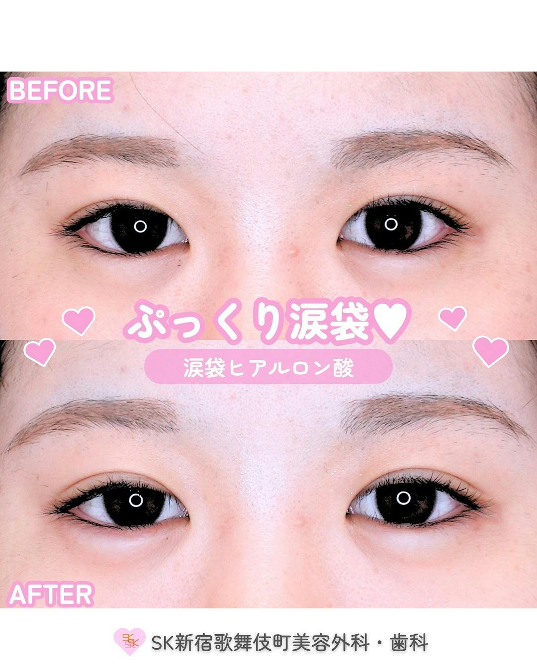 【女性・目元】涙袋ヒアルロン酸_before_aftar