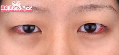 【20代女性・目元】クイックコスメティーク・ダブルNeo_before