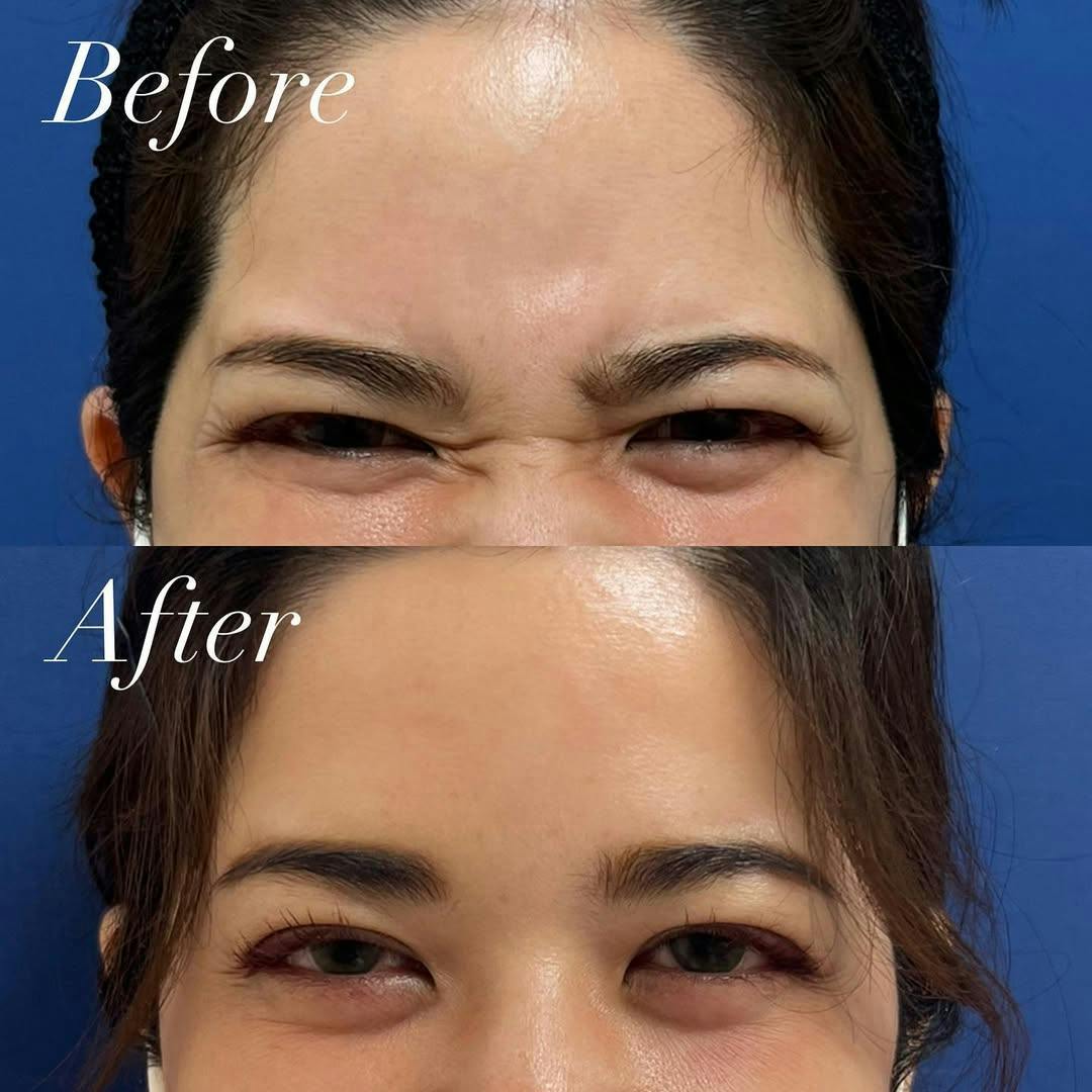 【女性・シワ】ボトックス_before_aftar