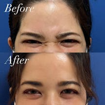 【女性・シワ】ボトックス_before_aftar