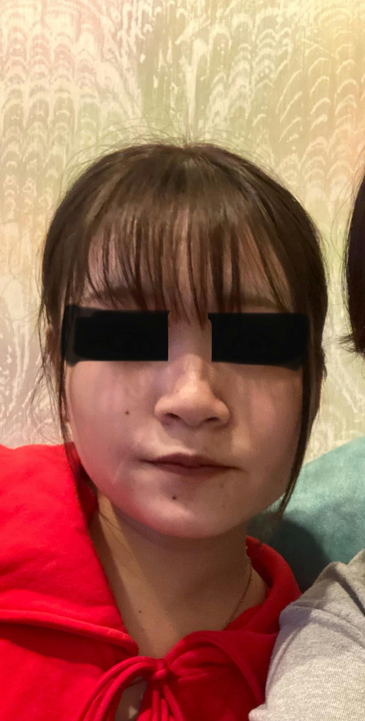TCB東京中央美容外科 新宿三丁目院でを受けたゆかさんの写真