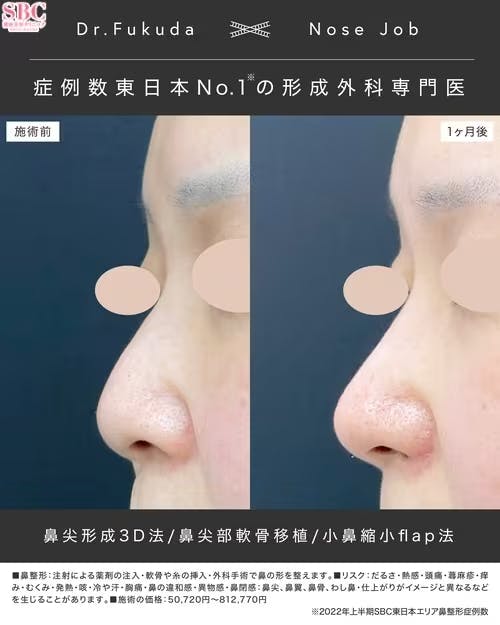【女性・鼻】鼻尖形成/鼻尖形成3D法（だんご鼻解消術）、鼻尖部軟骨移植、小鼻縮小（フラップ）_before_aftar