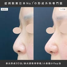 【女性・鼻】鼻尖形成/鼻尖形成3D法(だんご鼻解消術)、鼻尖部軟骨移植、小鼻縮小(フラップ)_before_aftar