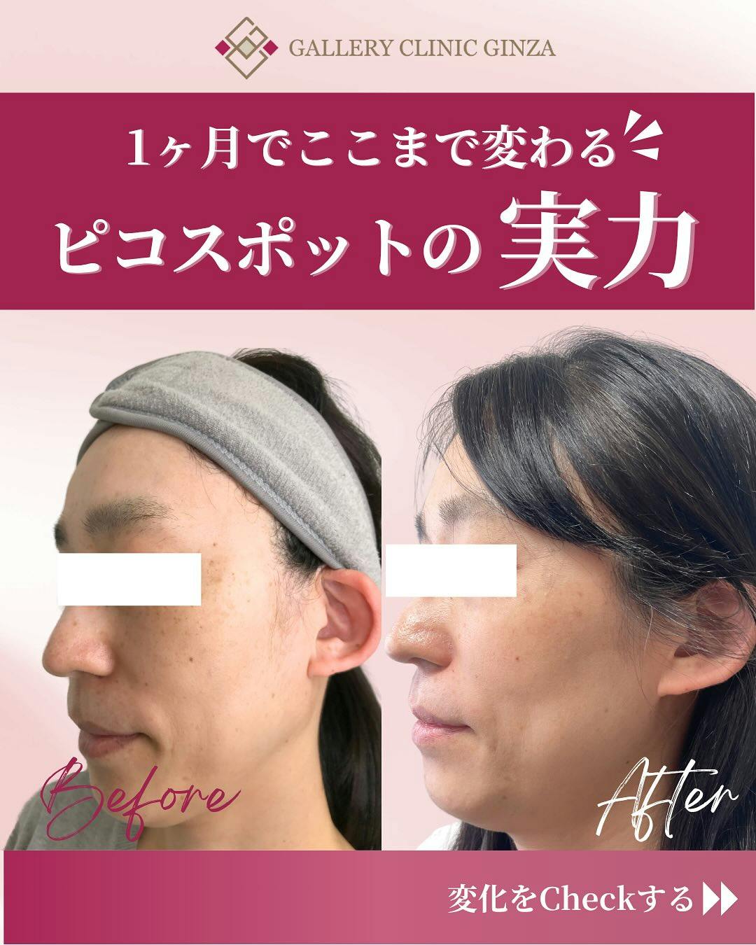 【女性・シミ】ピコスポット_before_aftar