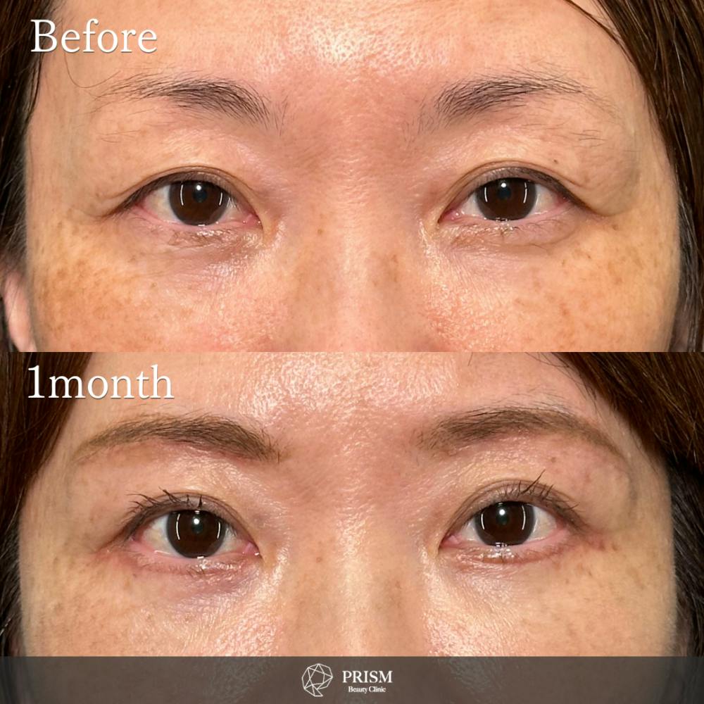 【50代女性・眉下】眉下リフト_before_aftar