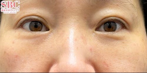 【40代女性・目元】裏ハムラ法_after