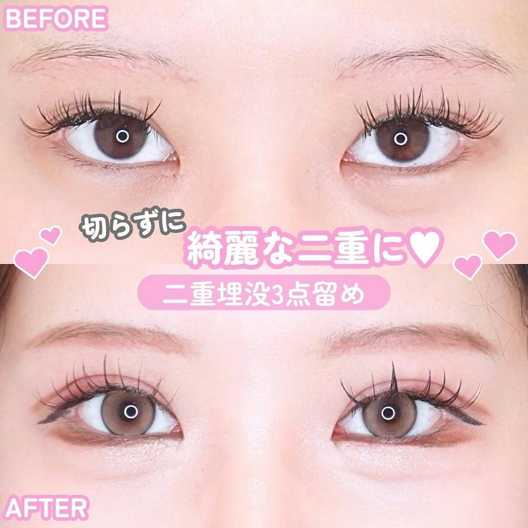 【女性・目元】二重埋没3点留め_before_aftar