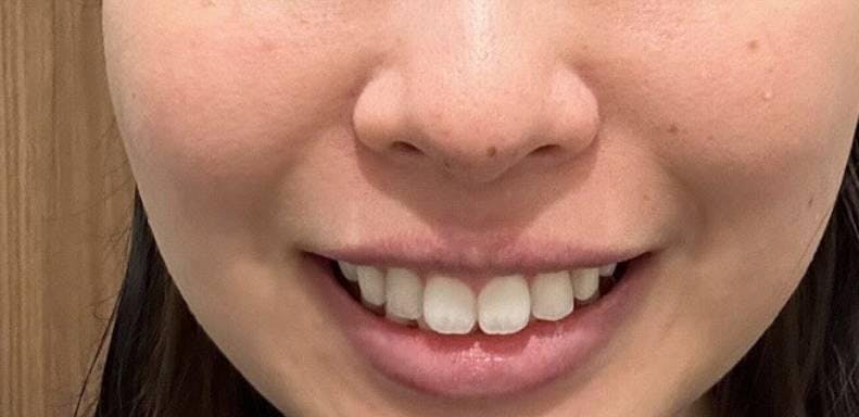 TCB東京中央美容外科 八王子院でガミースマイル治療（ボトックス・切開）：ガミースマイル治療（ボトックス注射）を受けたSABBYさんの写真