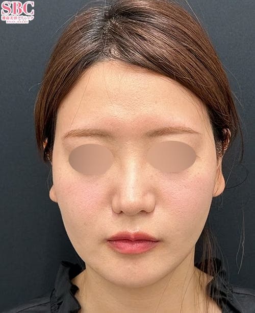 【20代女性・顔】小顔用脂肪吸引注射・エンブレイスRF・糸リフト_after