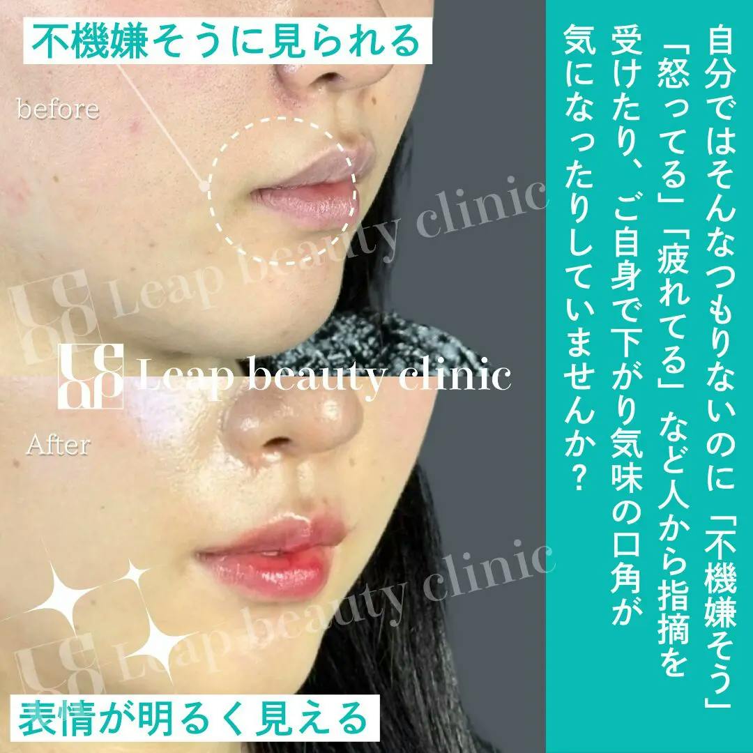 【20代女性・口角】口角挙上_before_aftar