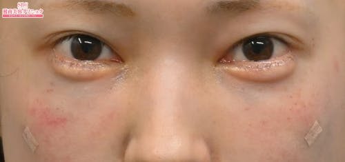 【30代女性・目元】目の下の切らないクマ・たるみ（ふくらみ）取り ナチュラル脂肪注射コンデンスリッチ ナチュラル脂肪注射ナノリッチ_after