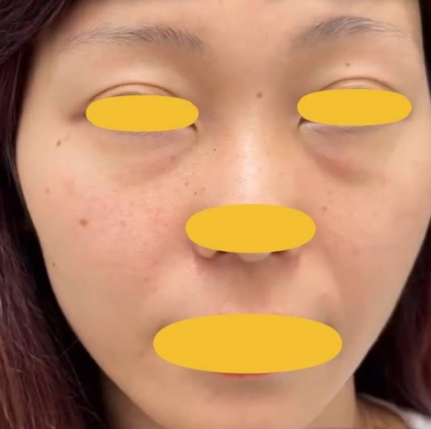 ルラ美容クリニック 名古屋院で目の下のクマ取り:目の下のクマ取りプレミアを受けたふなもさんの写真