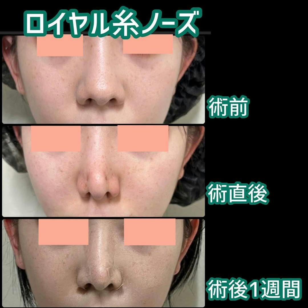【女性・鼻】ロイヤル糸ノーズ_before_aftar