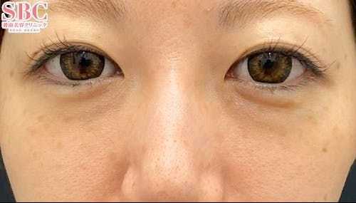 【30代女性・目元】裏ハムラ法 ナチュラル脂肪注射ナノリッチ VOV（ボブ）リフト_before