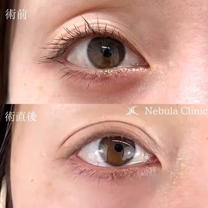 【女性・目元】二重埋没法_before_aftar