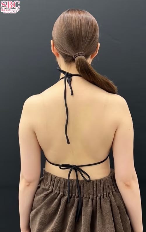 【女性・二の腕】根こそぎVASER脂肪吸引_before