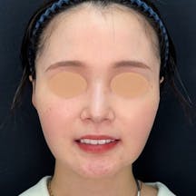 【女性・輪郭】美ボディ脂肪吸引_1month