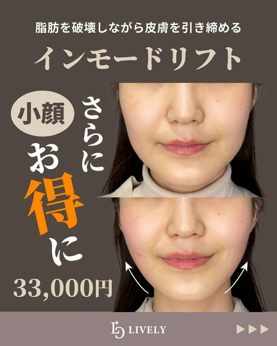 【女性・顔】インモードリフト_before_aftar