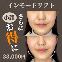 【女性・顔】インモードリフト_before_aftar