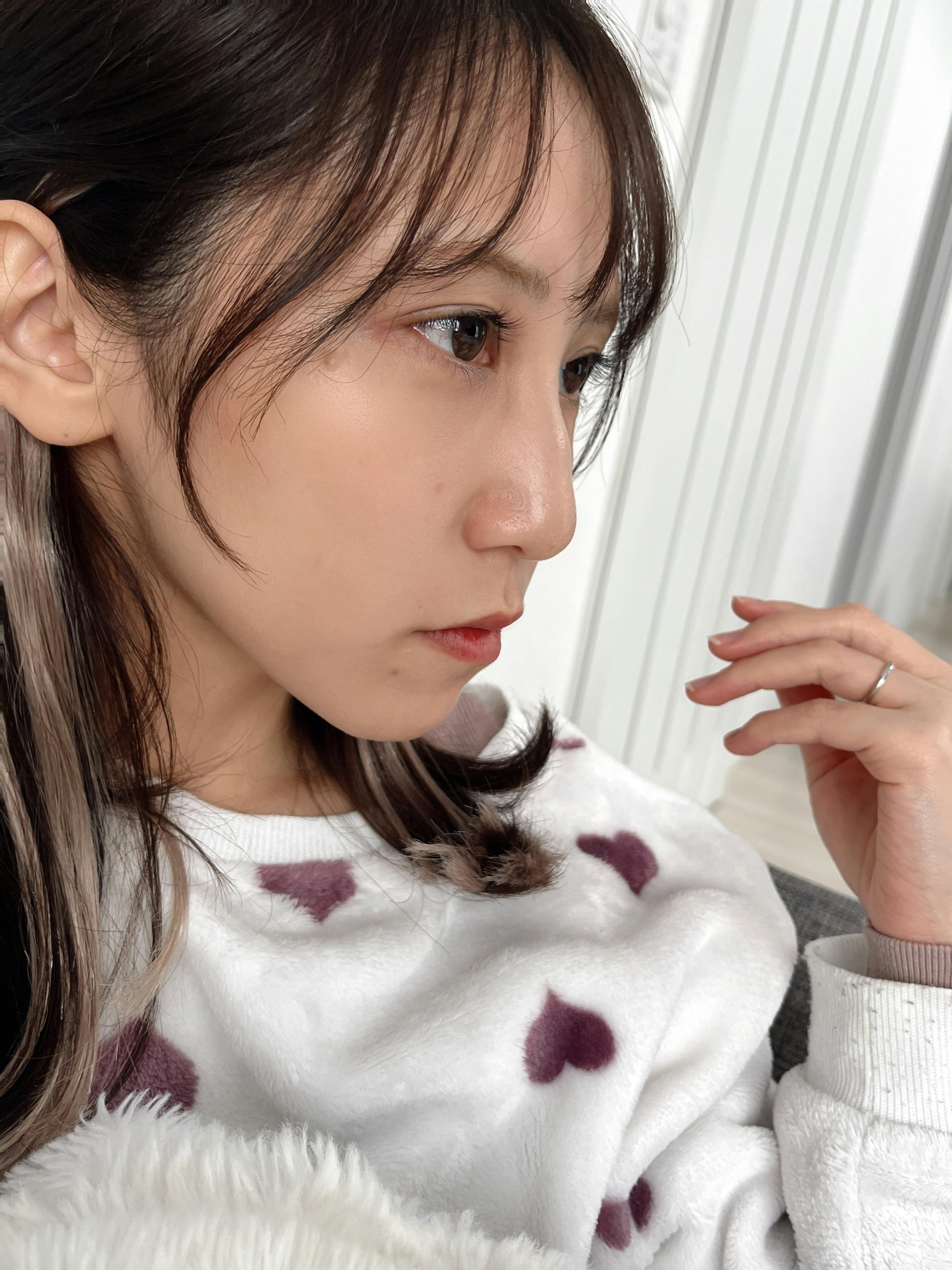 モーブビューティークリニック札幌大通(Mauve Beauty Clinic 札幌大通)で口横 脂肪溶解注射を受けたelleriさんの写真