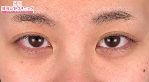 【女性・目元】線留めクロス二重術_after