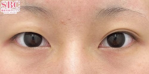 【20代女性・目元】クイックコスメティーク・ダブルNeo_before