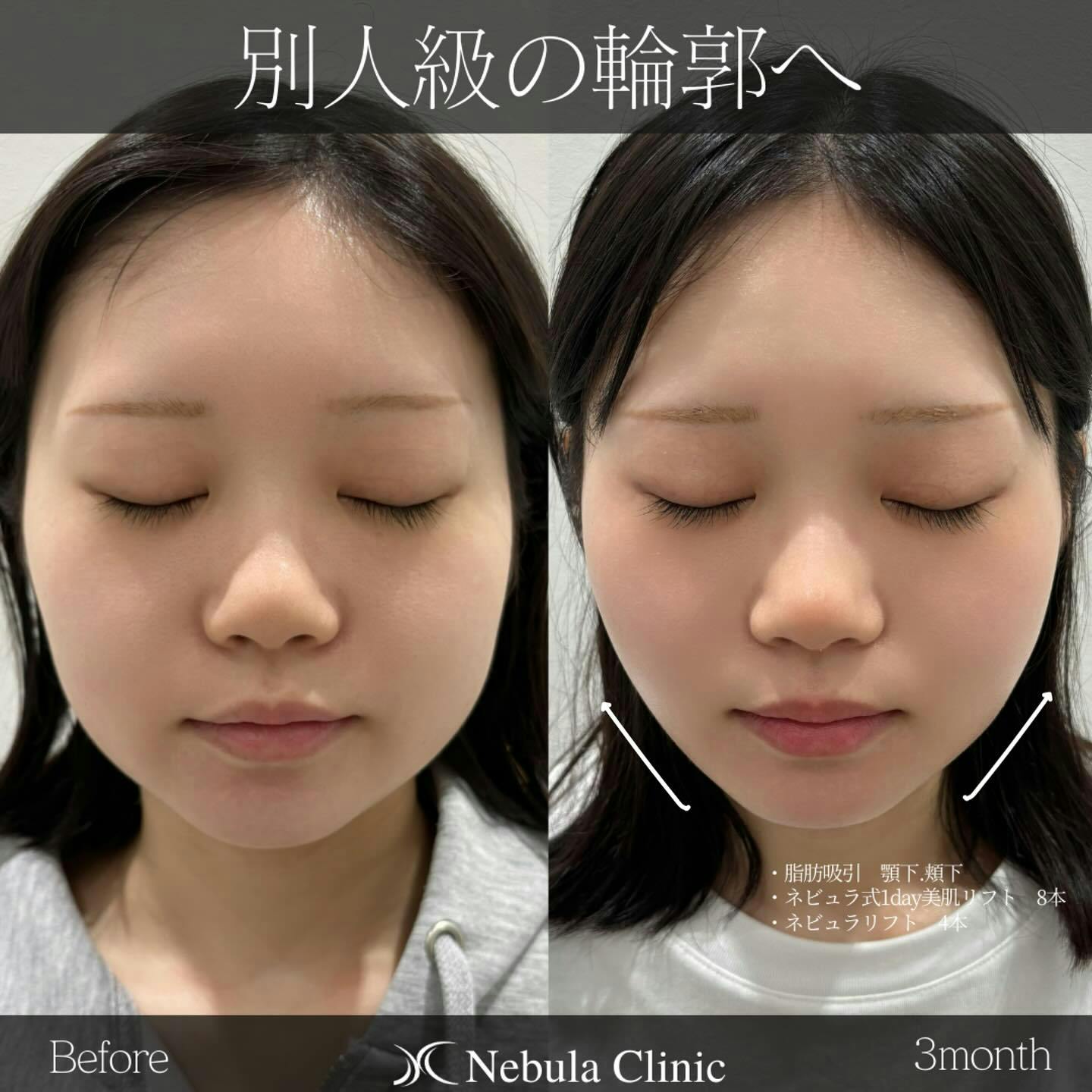 【女性・輪郭】脂肪吸引（顎下・頬下）、糸リフト_before_aftar